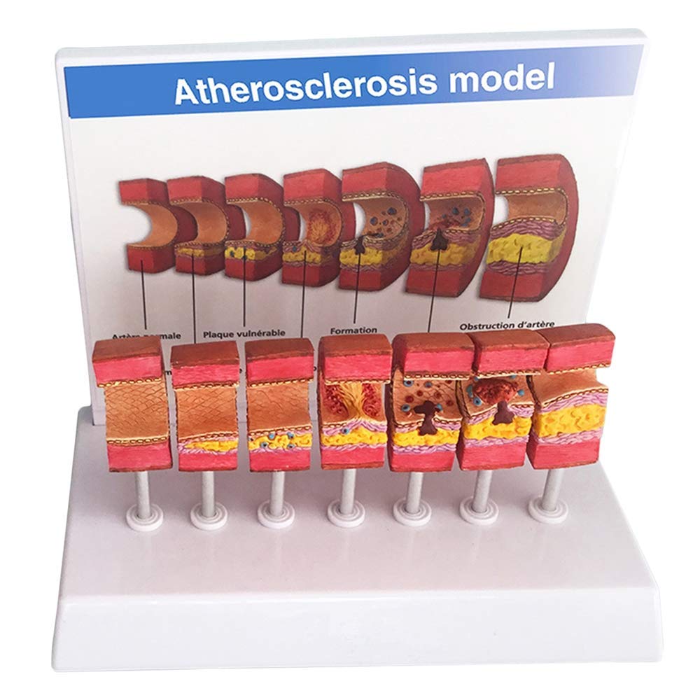 Buy DBSCD Artery Anatomical Model Anatomical Vessel Atherosclerosis