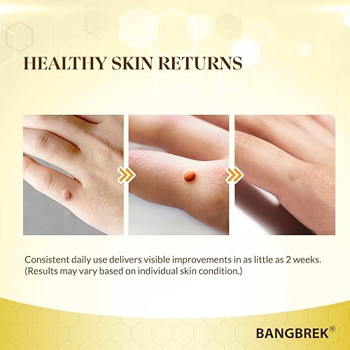 Miniatura 5 de Removedor de verrugas de veneno de abeja removedor de verrugas de acción rápida para eliminar callos de maíz de verrugas planas comunes plantares