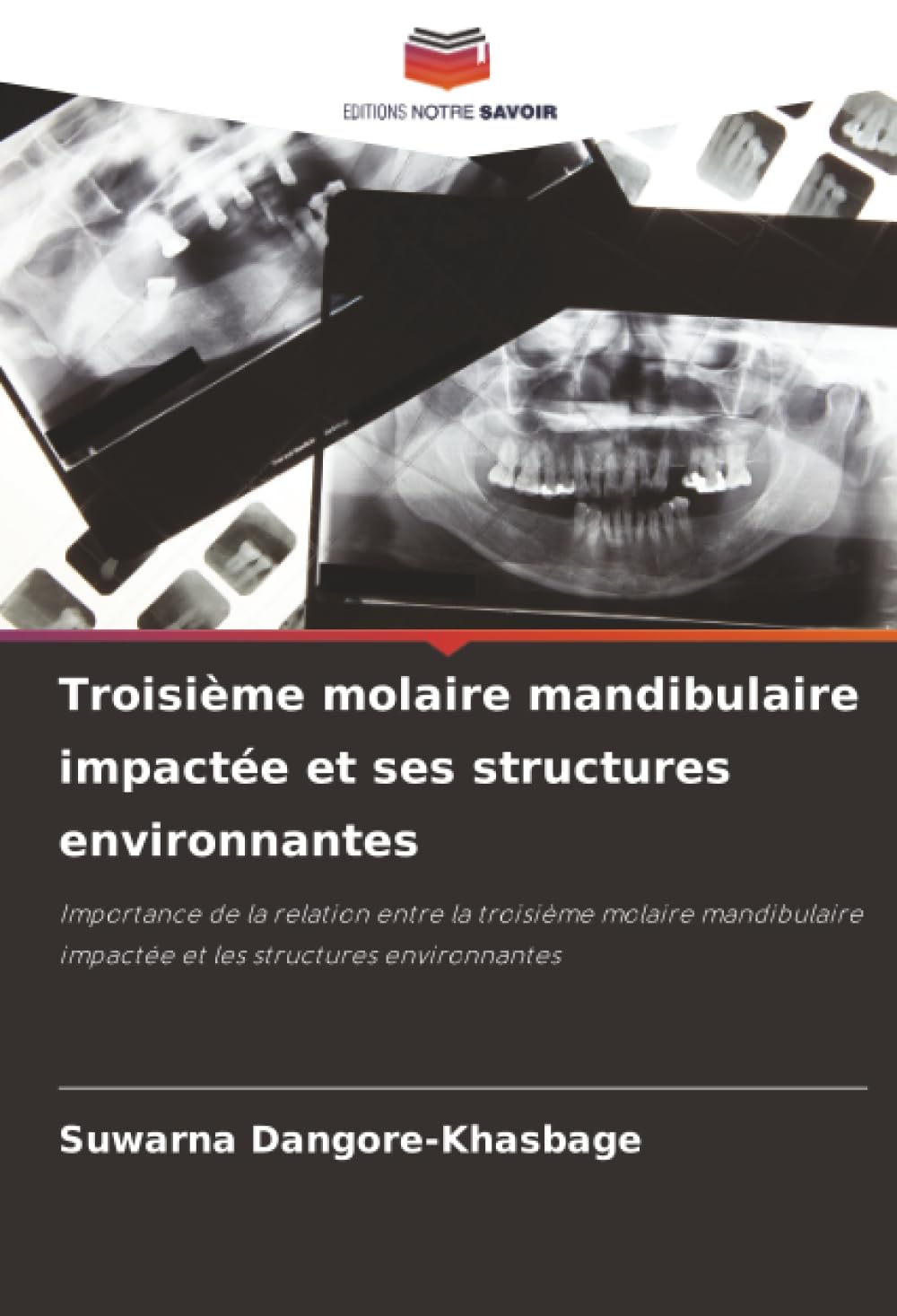 Troisième molaire mandibulaire impactée et ses structures environnantes: Importance de la relation entre la troisième molaire mandibulaire impactée et les structures environnantes