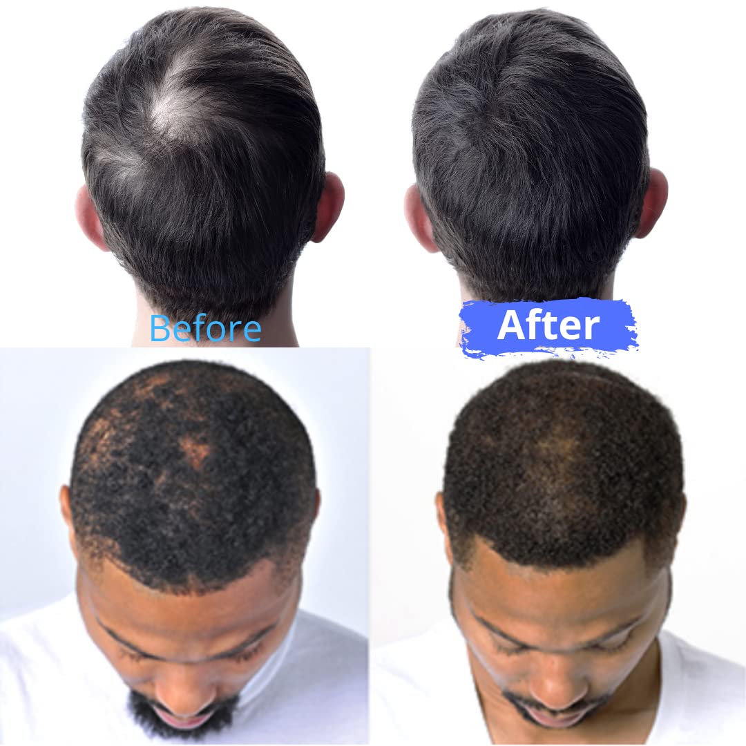 2 bottle Infinix Hair Thickening anti itchy soothing and Thinning hair protection - Thinning hair prevention tonic