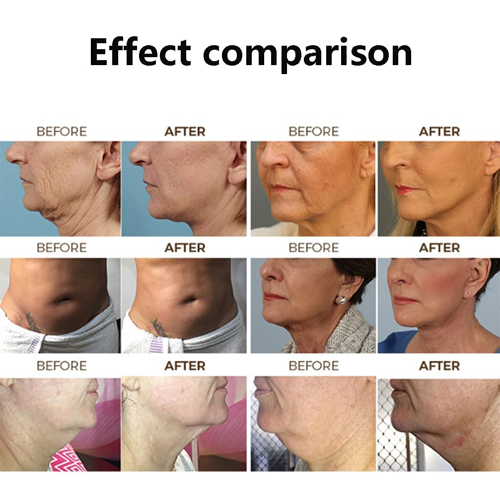 Hifu Ultramage 7D Machine with Vmax 2 in 1 Handle 7D Face Lifting