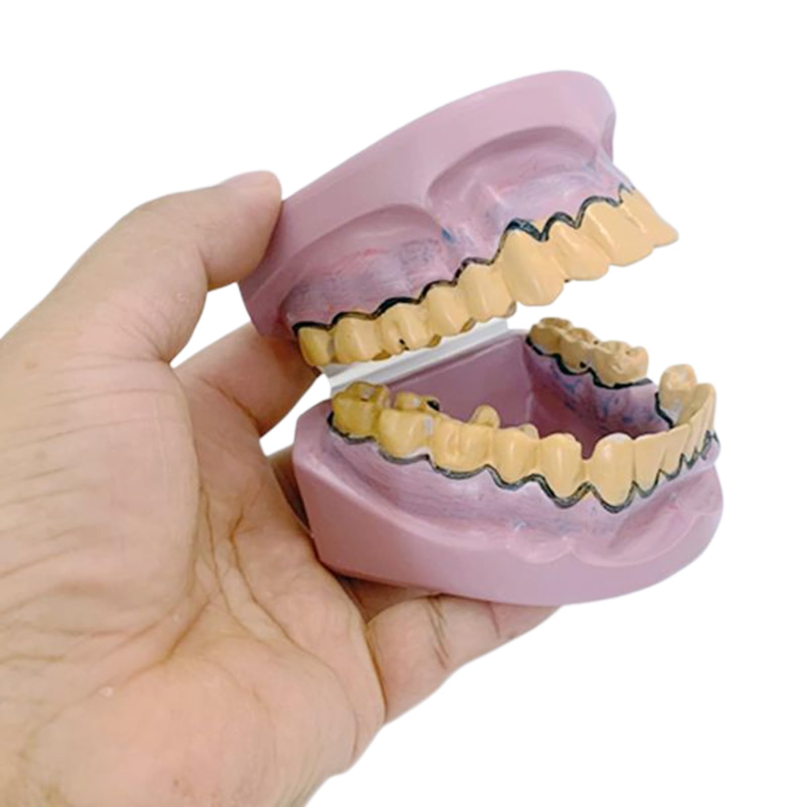 Modèle de pathologie Dentaire avec cavités et Caries dentaires Modèle d'anatomie Dentaire pour l'éducation Modèle de dent pour Exposition Dentaire