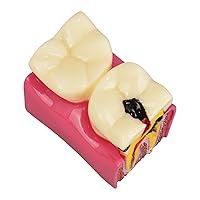 Vista 4 de Ultrassist Modelo de caries dental 6 veces caries dentales Modelo de caries bilateral Comparación bilateral Modelo de patología Dientes