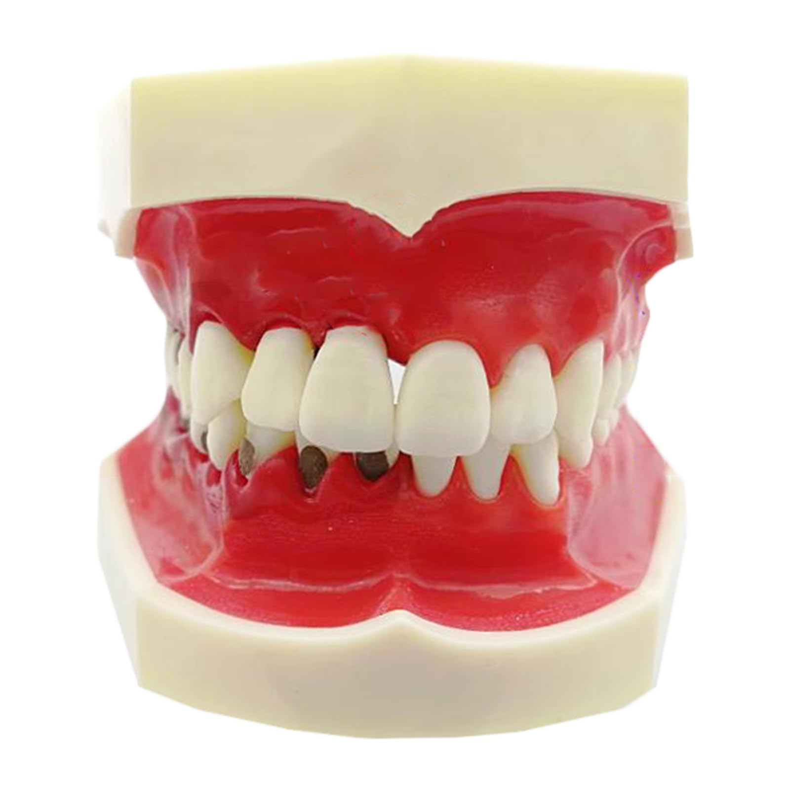 Dentales Zahnmodell für pathologische Parodontitis - Abnehmbares Zahnmodell für pathologische Zahnfleischerkrankungen - zur Kommunikation zwischen Arzt und Patient