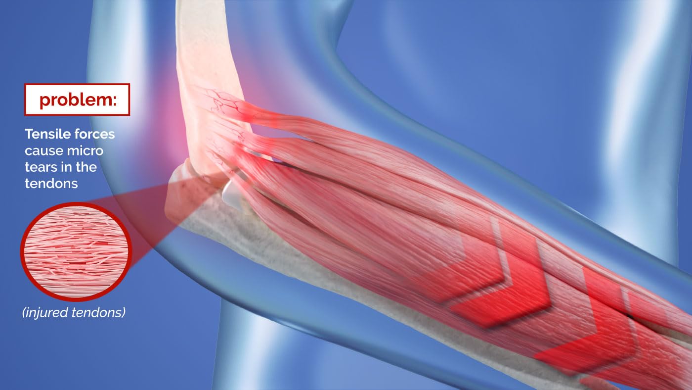 Masalo® Manschette MED - bei Tennisarm, Golferarm, Mausarm (Epicondylitis) (Größe 2 / rechter Arm)