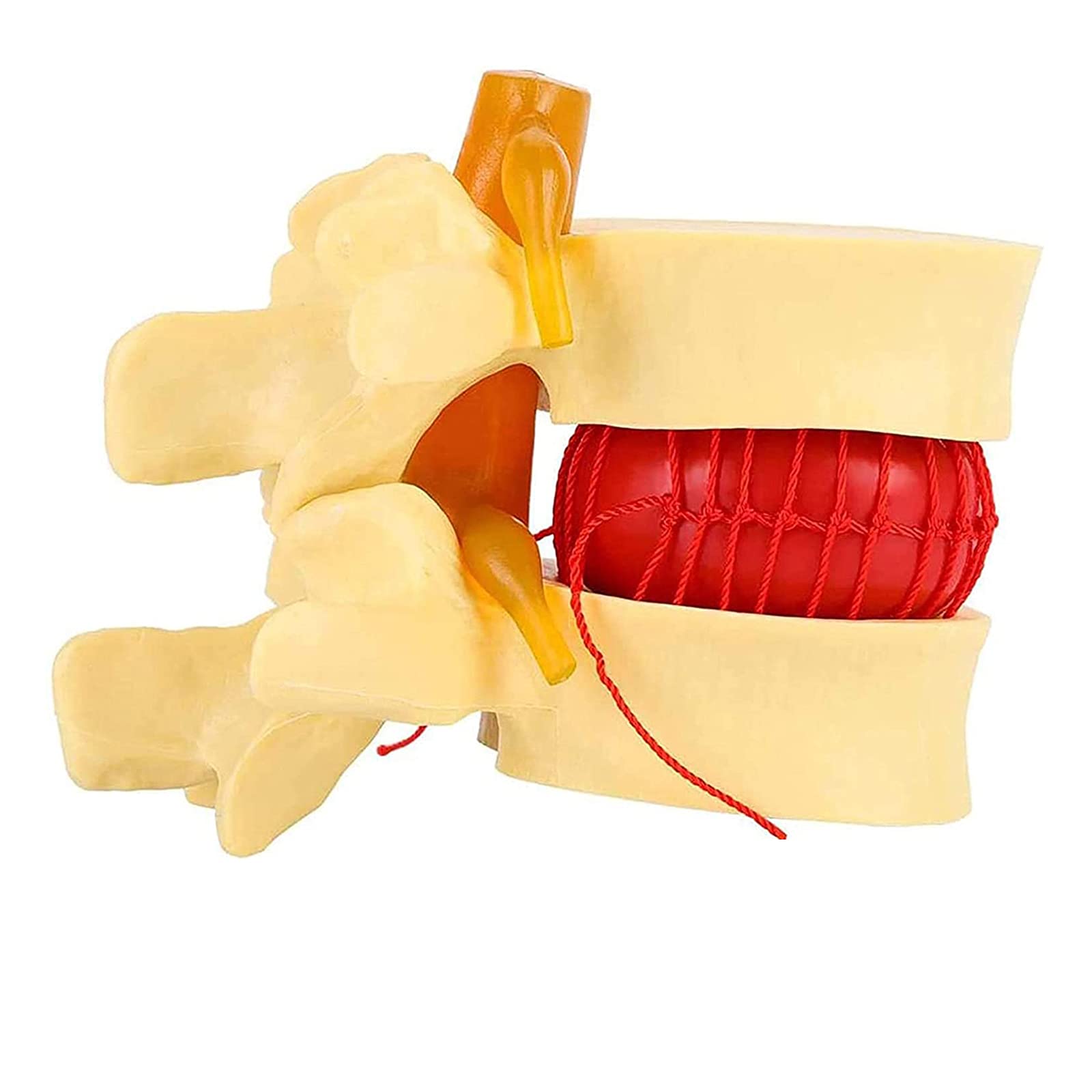 Human Lumbar Disc Herniation Model, Anatomy Spine Lumbar Disc Herniation Teaching Model, Lumbar Herniation Intervertebral Disc for School Teaching Demonstrating Lab Supplies