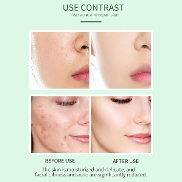 Aoseiens Acne Spot Treatment Serum for Face with 2% Salicylic Acid Face Serum for Acne Prone Skin Soothing Redness Clarifying Oil Skin Care for Teens and Adults