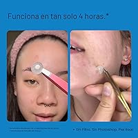 Vista 6 de Peach Slices Puntos de acné Parches hidrocoloides para el acné Para Zits, imperfecciones y brotes Vegano Libre de crueldad Parches