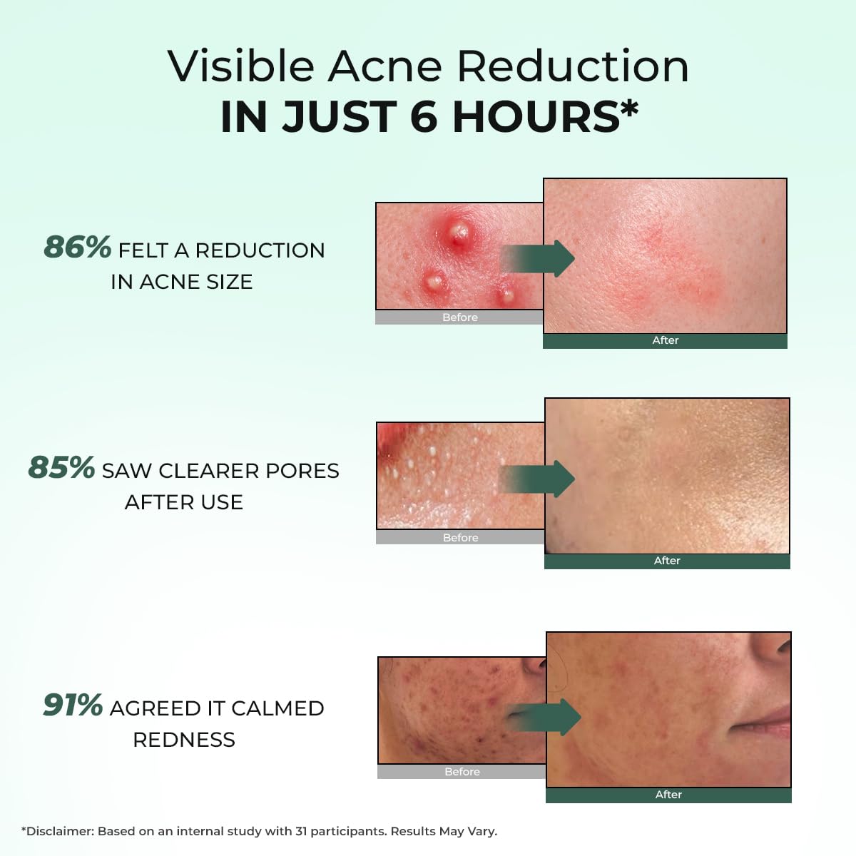 Conscious Chemist® Rapid Relief Acne Spot Corrector Gel 15g | 2% Salicylic Acid & Azelaic Acid Acne Spot Treatment | Pimple Removal Gel for Active Acne, Redness & Dark Spots | Fast-Acting Spot Corrector for Men & Women 3