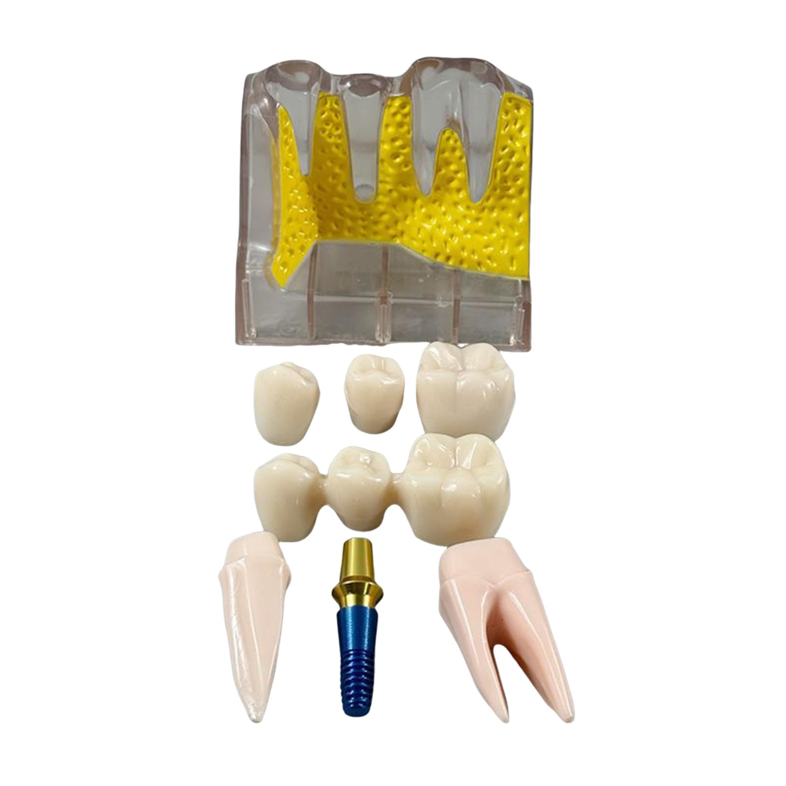 YRQMGSF 4 Times Dental Implant Model Dental Implant Model with Removable Crown Bridge for Class Education and Studying,Yellow,8cm