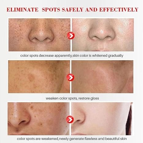 Pigment Spot Remover Face 2025 Upgrade Anti Pigment Spot Face Lightening Cream Cream Against Pigment Spots Melasma and Age Spots Pigment Spot Cream Test Winner (2)