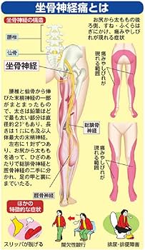 坐骨神経痛 最新最強自力克服大全 (わかさ夢MOOK 130) | わかさ出版