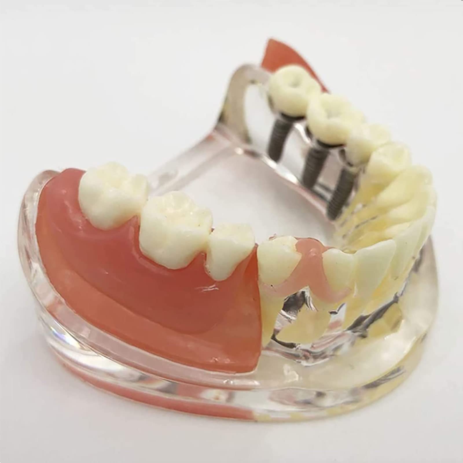 PEAMAN Modello di Cure odontoiatriche, Modello di impianto Dentale e restauro dei Denti a confronto con gengiva e Protesi Rimovibile per Lo Studio e la dimostrazione didattica