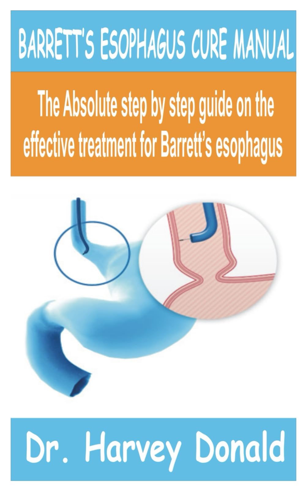 BARRETT’S ESOPHAGUS CURE MANUAL: The Absolute Step by step guide on the effective treatment for barrett’s esophagus