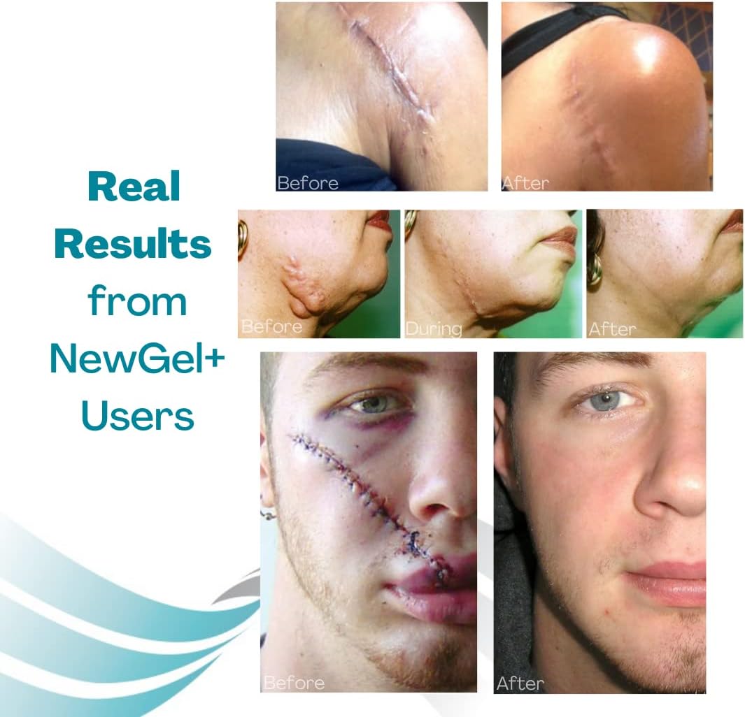 NewGel Advanced Silicone Professional Scar Treatment Tape by MyNewGel, Ultra-Thick, for Abdomen, C-Section, Keloids, Burns, Reusable, 2" x 24" Strip - Beige - Image 6