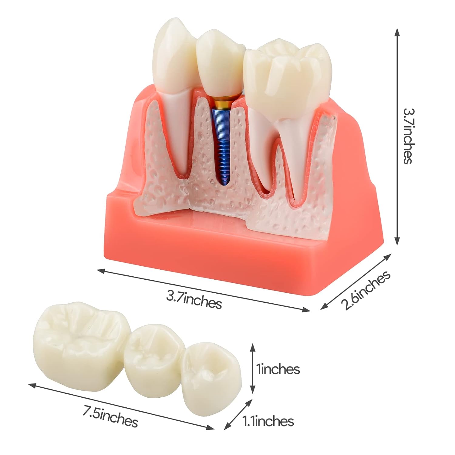 Buy Ultrassist Dental Implant Model for Patient Education, 4 Times