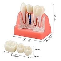 Vista 5 de Ultrassist Modelo de implante dental para la educación del paciente, 4 veces implante dental, modelo de corona y puente para presentación-rosa