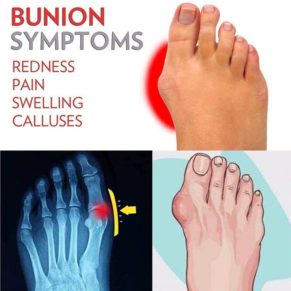 Sandalias Plataforma Punta Abierta para Mujer Sandalias corrección de juanetes Piel sintética Chanclas Verano Dedo Gordo del pie Corrección de la Sandalia,Caqui,36