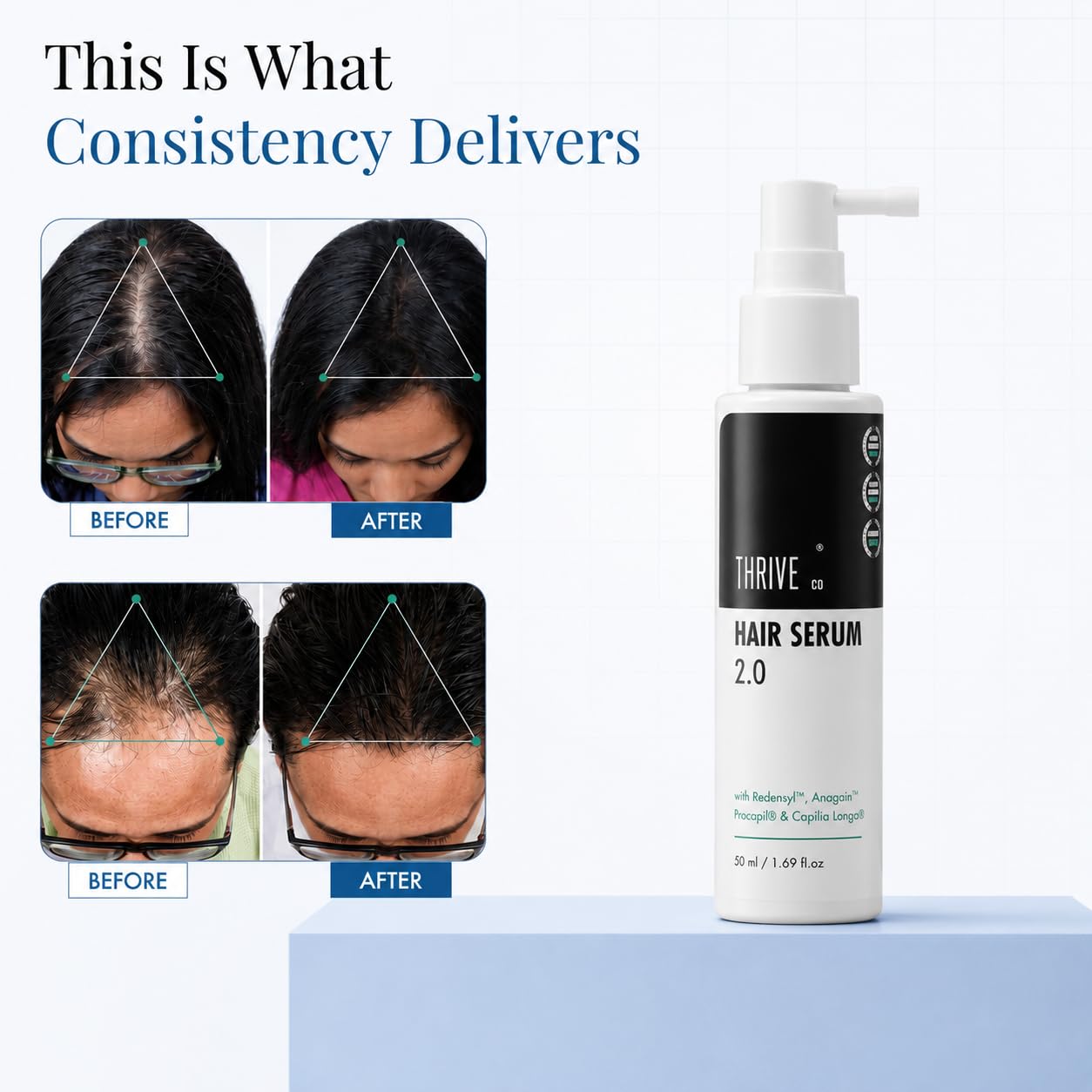 ThriveCo Hair Growth Serum For Scalp, Spray 50ml | Advanced Patent Filed Clinically Proven Scalp Treatment for Hair Fall Control & Regrowth | British Medical Publication | Redensyl, Anagain, Regendil®, Rosemary Oil | Lightweight, Non-Sticky Solution | Men & Women 2