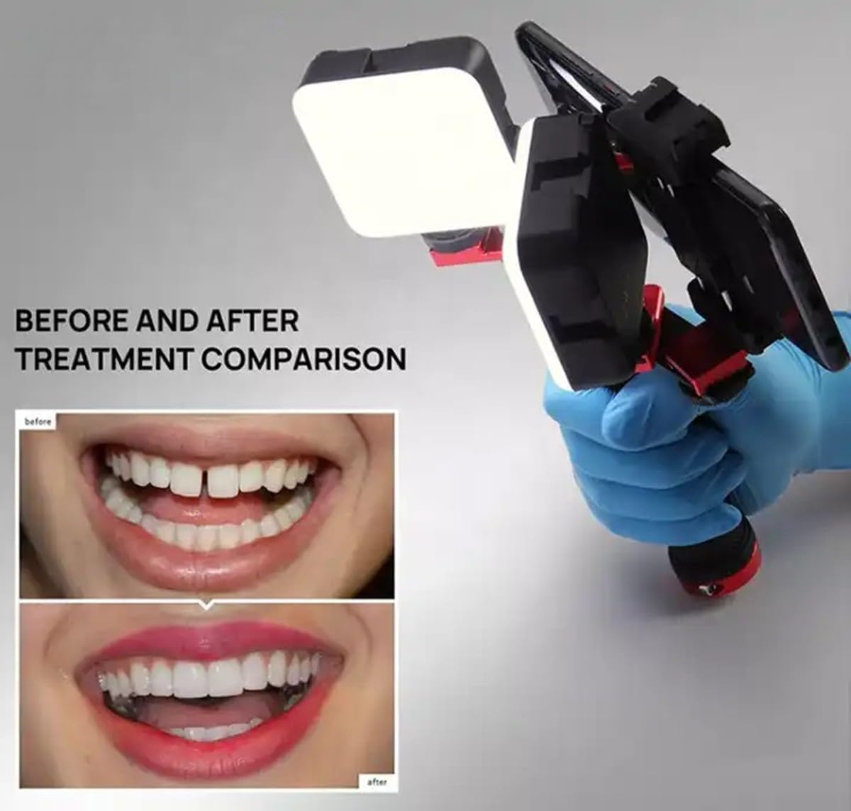 Dental Photograph Fill Light for Dentist Flash Light with 75mm Mobile Phone Macro Lens