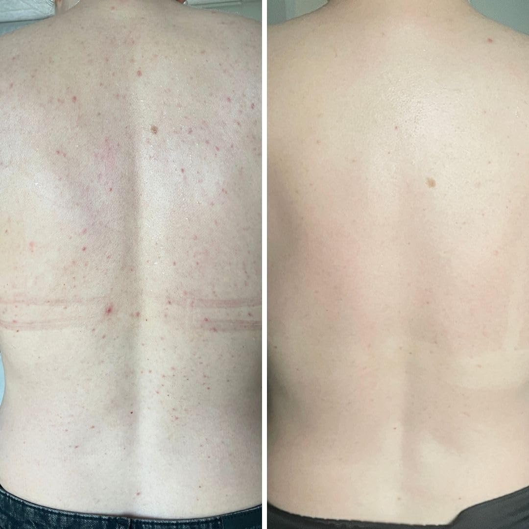 Spray z kwasem salicylowym przeciwko pryszczom, zanieczyszczonej skórze i zatkanym porom – z 2% kwasem salicylowym i glikolowym do głębokiego oczyszczania porów