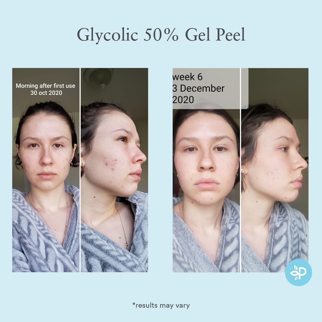 Glycolic Acid Before And After Photos