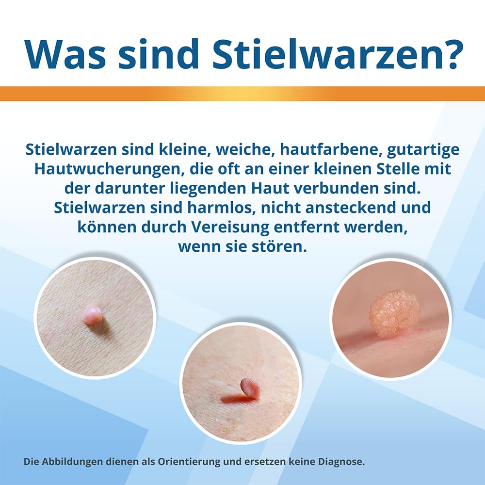 EndWarts EXTRA: Stielwarzen behandeln, Vereisungsmittel zur Behandlung von Stielwarzen an Hals, Brust & Achseln, 9-Einweg-Spitzen & 9 Pflaster, Aufnäher,Spray