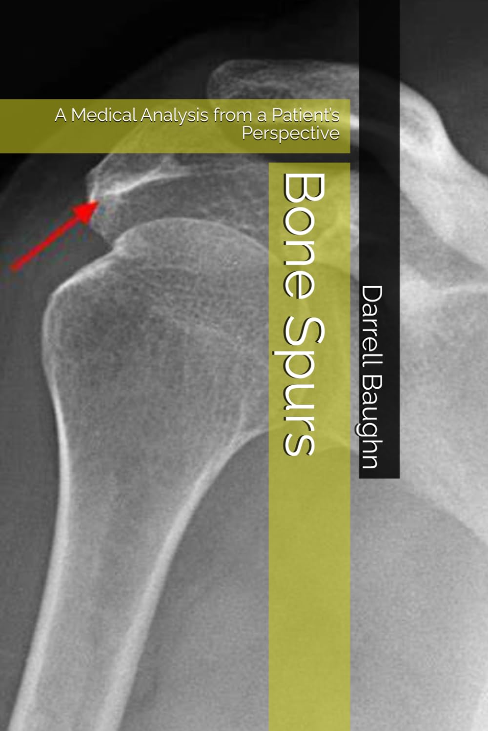 Bone Spurs: A Medical Analysis from a Patient’s Perspective