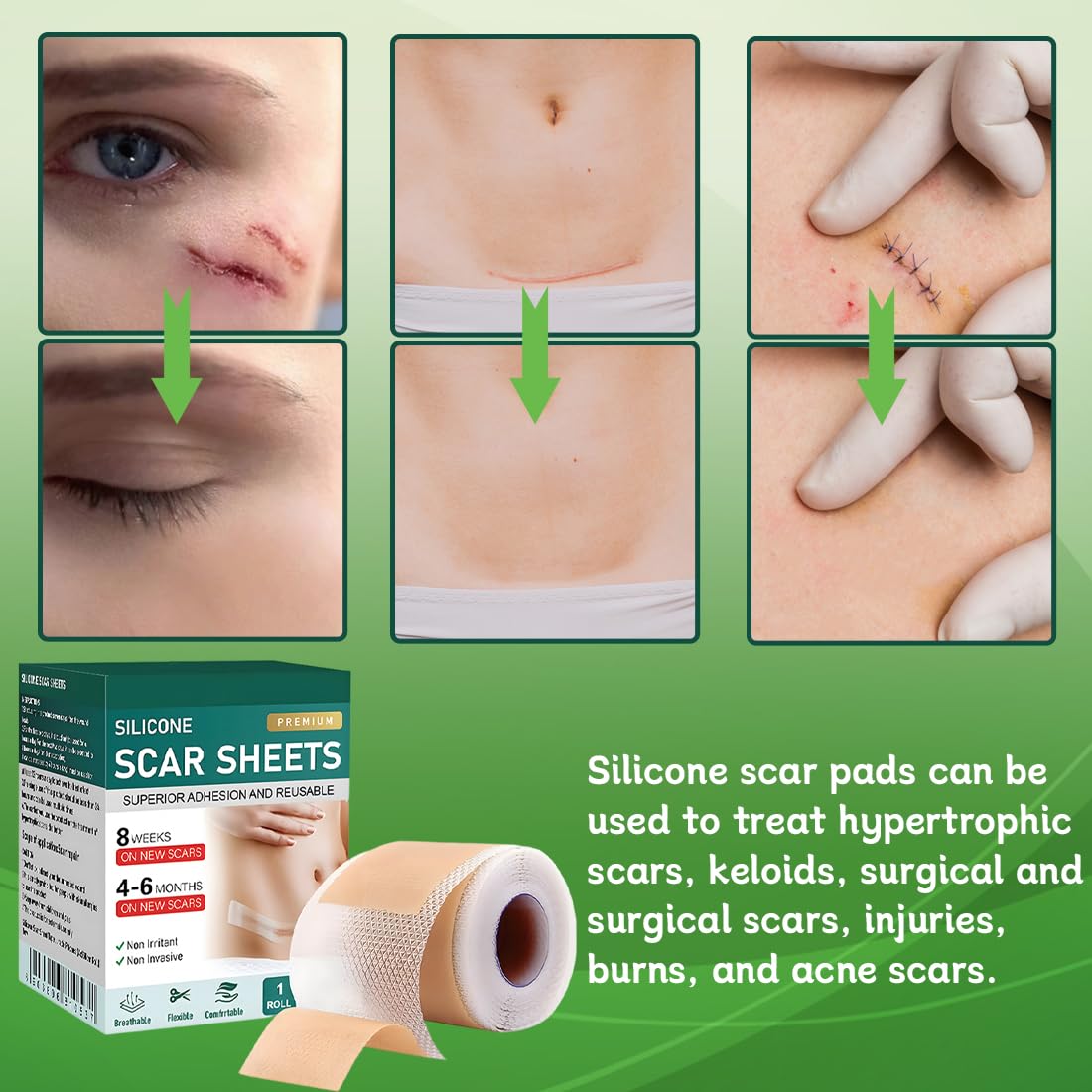 GXGM Pansement Silicone Cicatrice,Silicone Scar Sheets,cache cicatrice soleil,Scar Tape Patch,bande silicone cicatrice (4cm x 150cm)