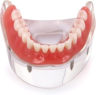 Dentalmall Dental Implant Teeth Demo Model Overdenture Restoration with 4 Implants Model M6003