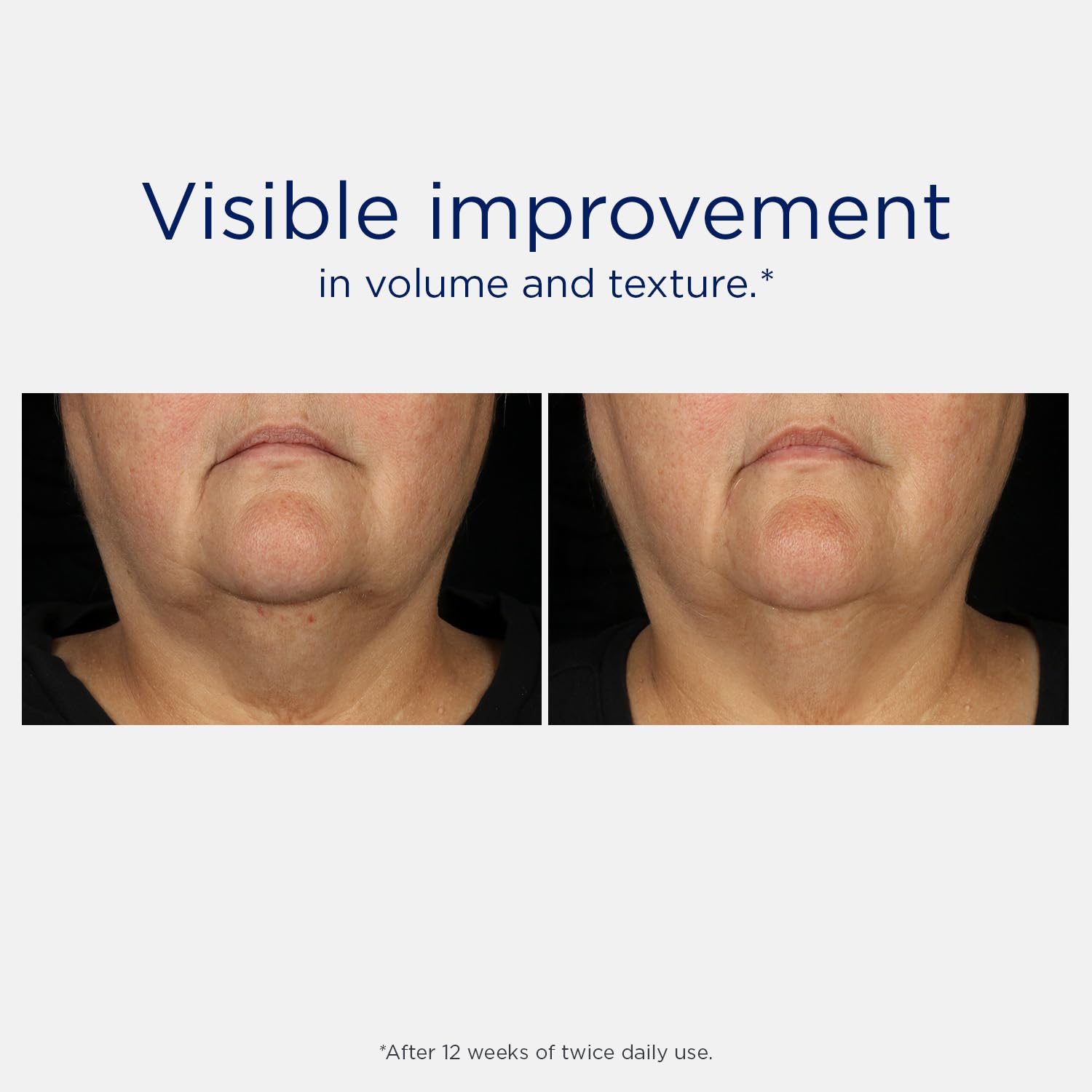 NEOSTRATA Tri-Therapy Lifting Serum, New & Improved Formula, 3D Volumizer, Lifting and Firming Antiaging Serum with Hyaluronic Acid Oil-Free Fragrance-Free, 1 fl. oz. - Image 7