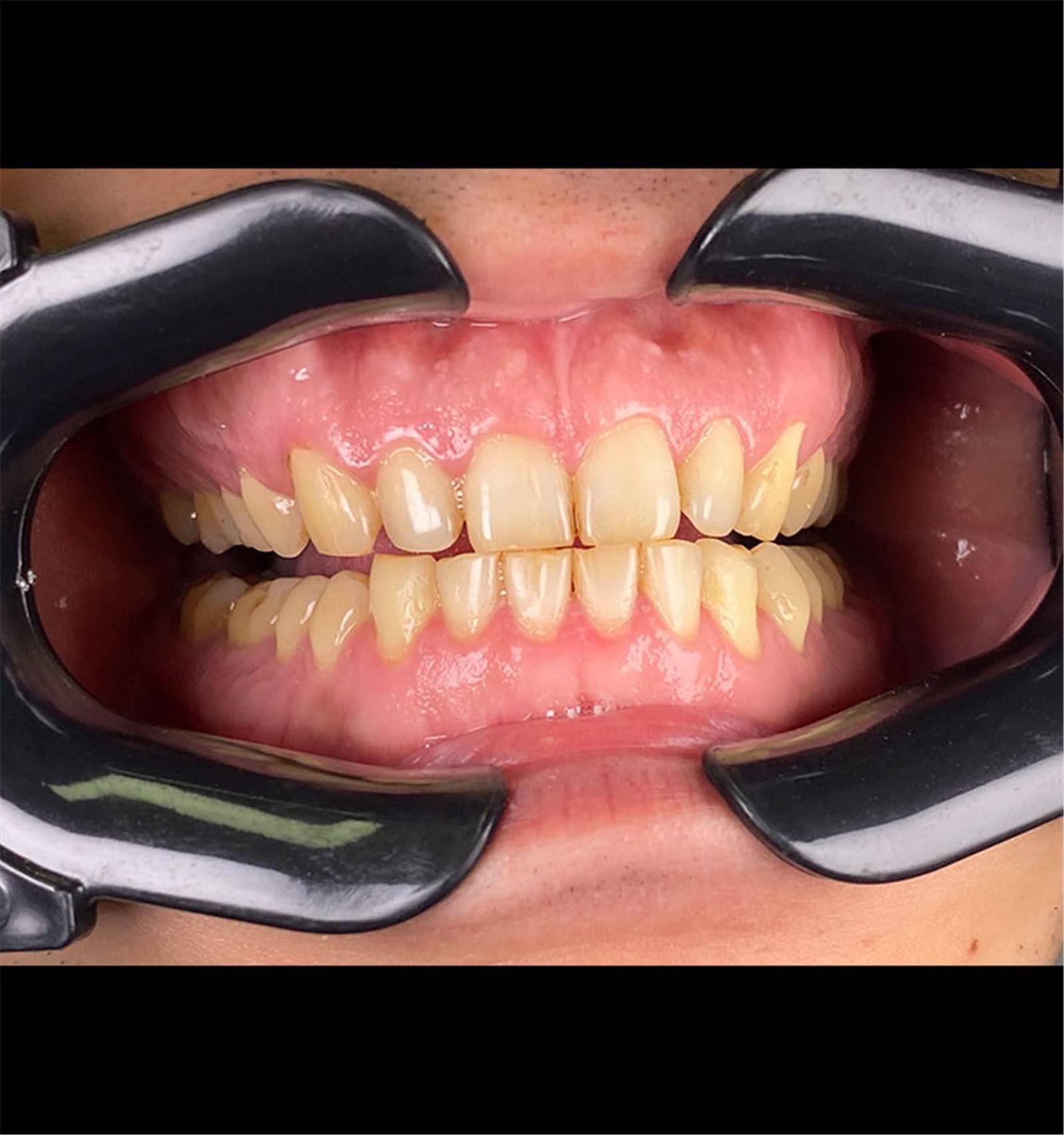 DIRIGIÓ Luz de Flash de fotografía Dental, fotografía móvil DIRIGIÓ Ligero de la Foto del teléfono Ligera de la Linterna, Equipo de fotografía Dental