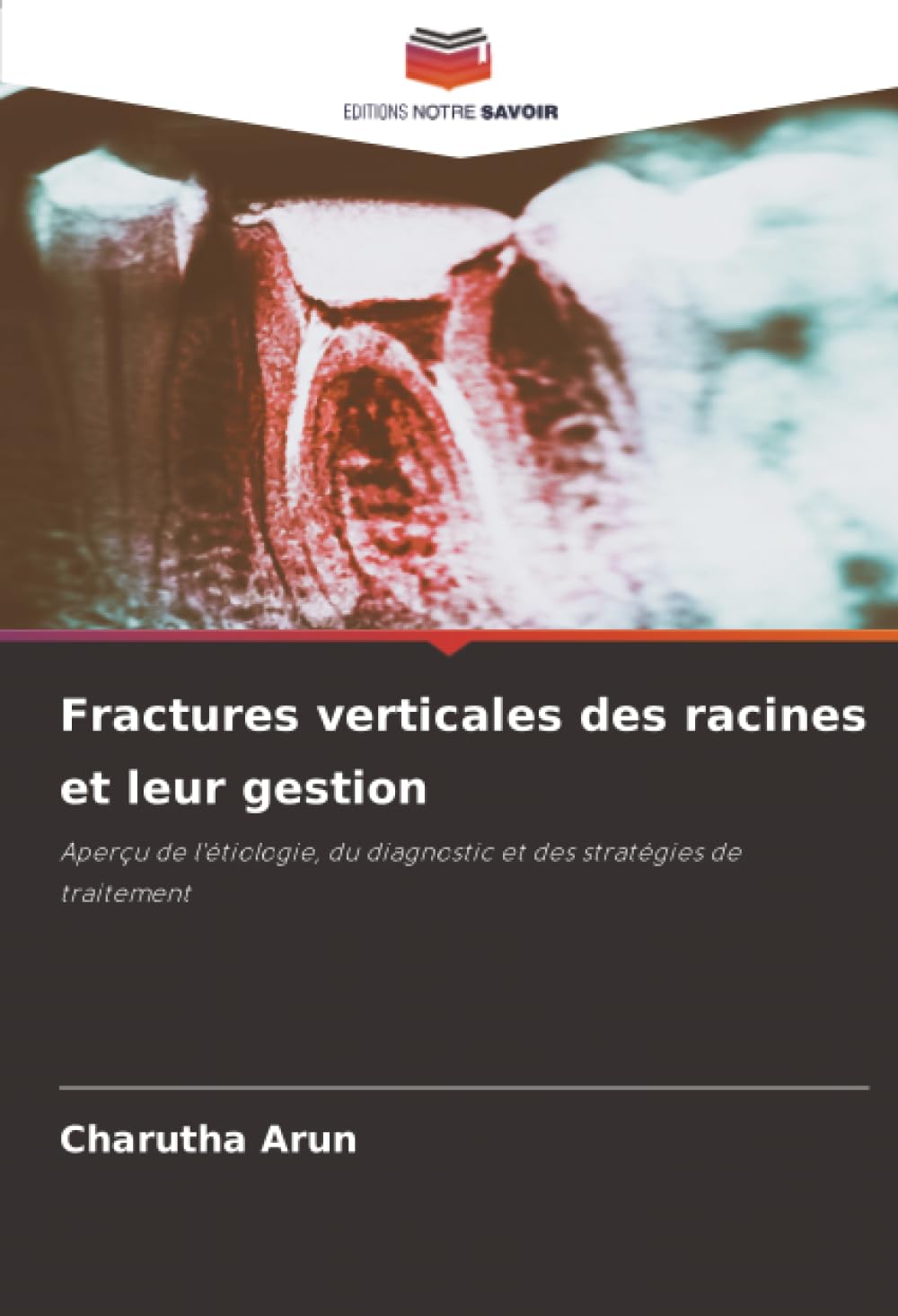 Fractures verticales des racines et leur gestion: Aperçu de l'étiologie, du diagnostic et des stratégies de traitement