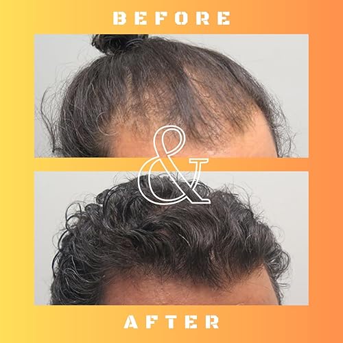 Miniatura 5 de RU58841 Solución al 5% (50 mgml) - Bloqueador DHT - Tratamiento avanzado para la pérdida de cabello - Tónico capilar anti-andrógeno - Promueve el