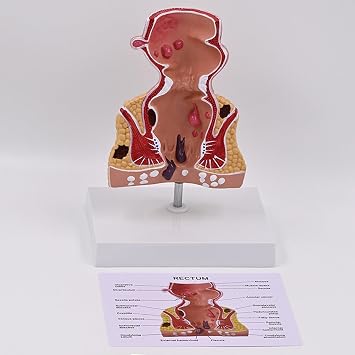 Rectum Anatomy and Pathology Model, Magnify 1.5 Times, with English Instruction Card, for Medical Demonstration Teaching Research