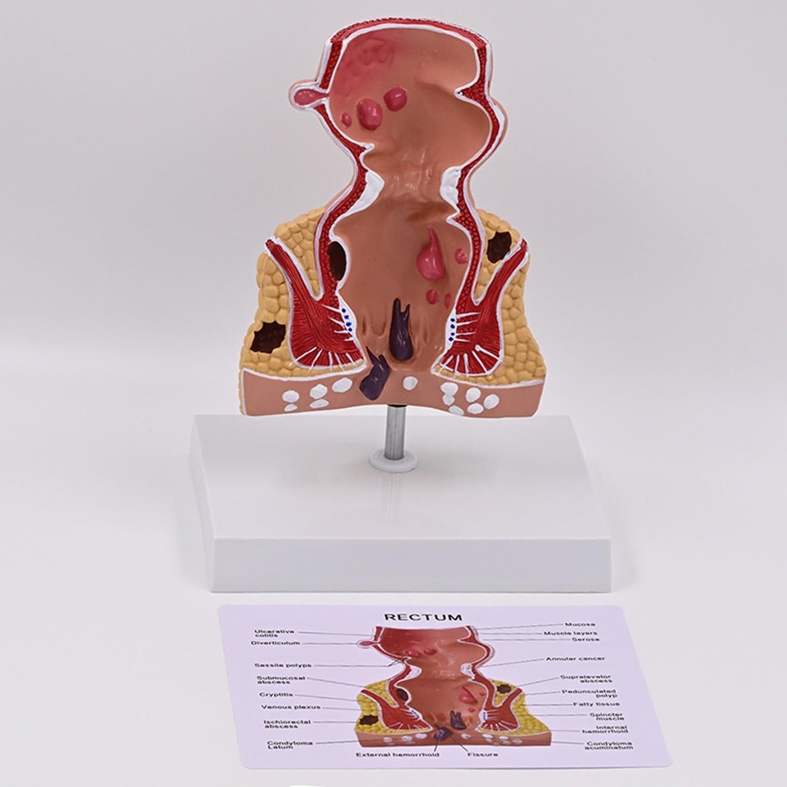 Modèle d'anatomie du rectum AMITD à sections amovibles pour l'analyse des pathologies