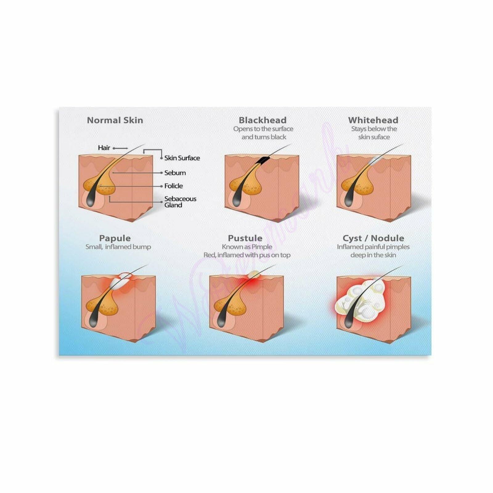 IDGTTLDF Informational Acne Face Mapping Chart Facial Zones Guide Canvas Print Wall-Art for Skincare Enthusiasts Home Decor Framed,12x18inch(30x45cm)