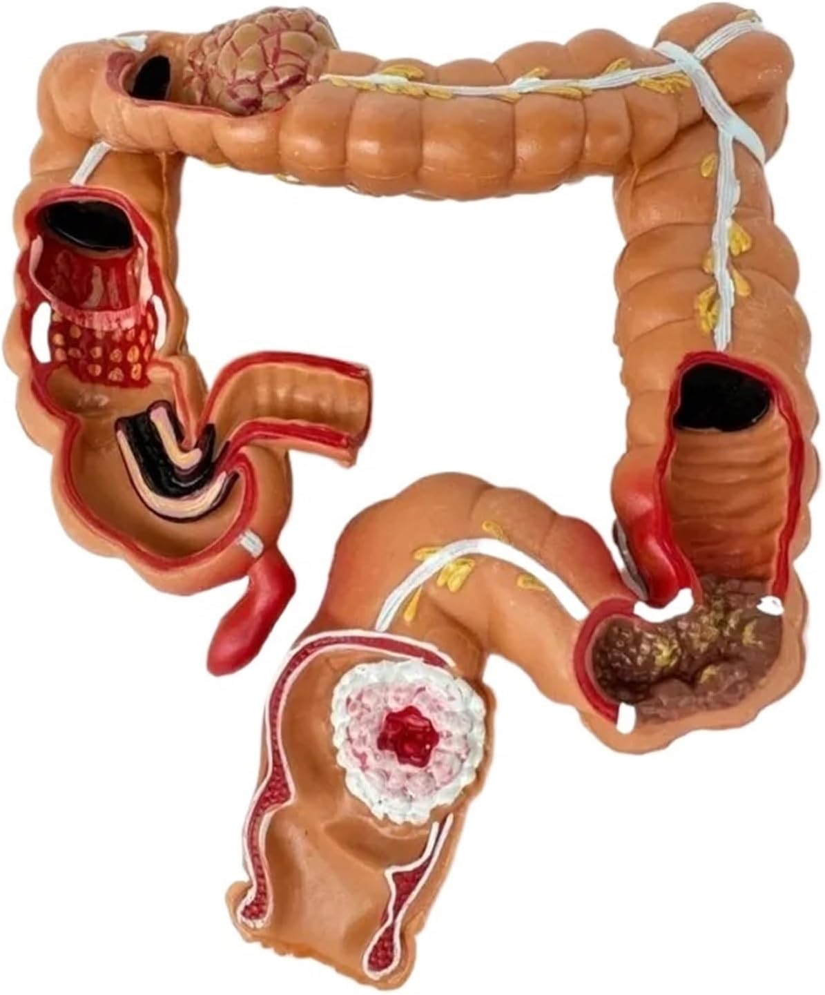 Human Colon Pathological Colorectal Cancer Large Intestine Gastrointestinal Anatomical Model