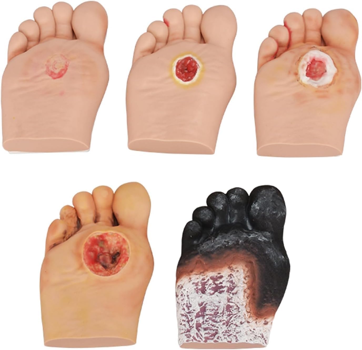 Diabetic Foot Care Model, Purulent Wound Lesions Grade 1-5 Diabetic Foot Simulator Model for Anatomy, Physiology, Wound Care Demonstrations Tool.