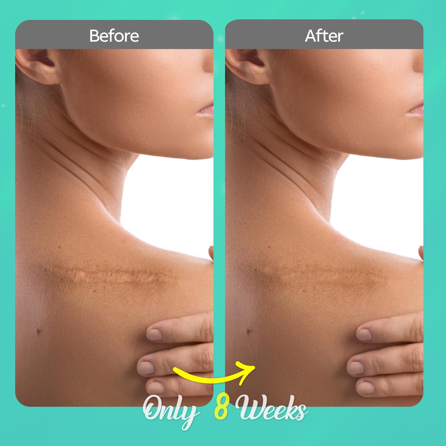 Scar Cream Keloid Bump Removal: Advanced Silicone Scar Gel – Smooth & Soothe the Look of Scars, Stretch Marks, and Skin Blemishes – 1 oz - Image 2