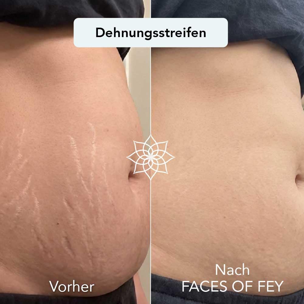 FACES OF FEY Derma roller – 192 prawdziwe igły – profesjonalny mikronakłuwanie do domu – wałek igłowy (zestaw hialuronowy 0,75 mm)