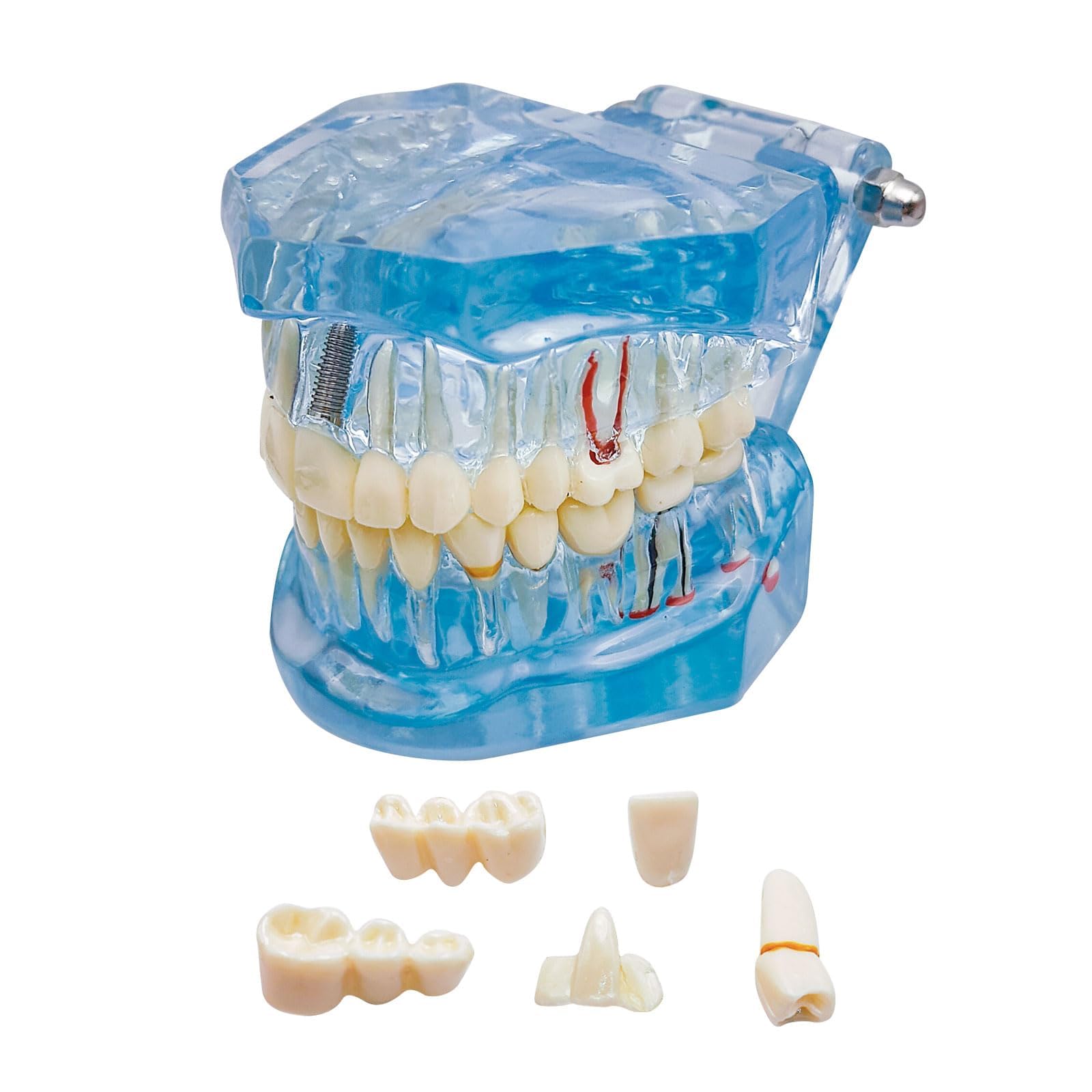 Windplusya Transparent Disease Teeth Model with Dental Implant Bridge, Dental Teach Crown Bridge Removable Model, Tooth Model for Patient and Dental