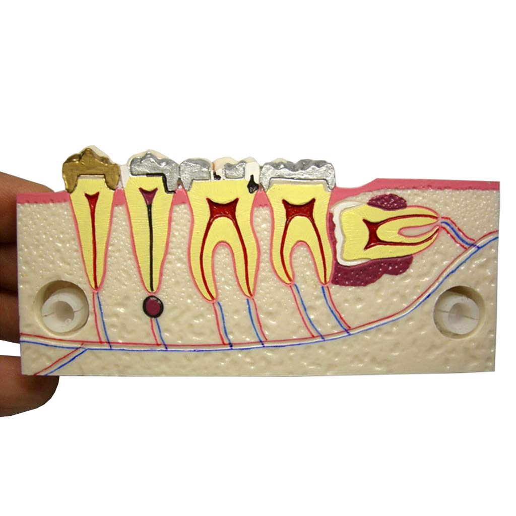 Sjdopulse Dental Teeth Anatomical Model - Dental Implant Study Analysis Teeth Model - Right Lower Posterior Tissue Anatomical Decomposition Model