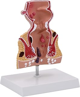 1.5X Human Rectum Model with Common Pathologies, Replica for Anatomy and Physiology Education, Anatomy Model Human Rectal Lesion Model Fistula Fistula Fissure Pathology Teaching Model