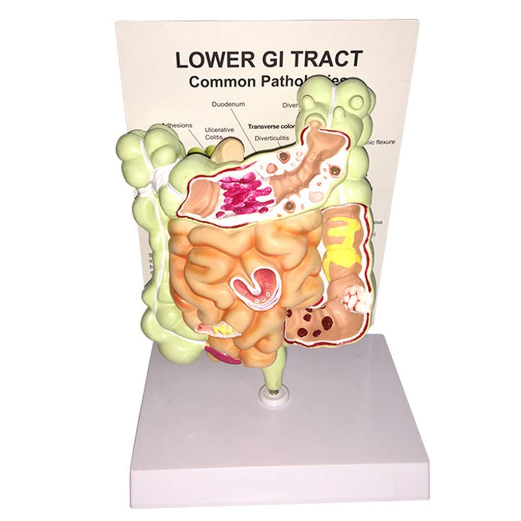 Educational Model Human Digestive System Model Human Large Intestine Pathology Model Gut Anatomy Intestinal Lesion Cecal Rectum Duodenal Ulcer Anatomical Model,Medical Models