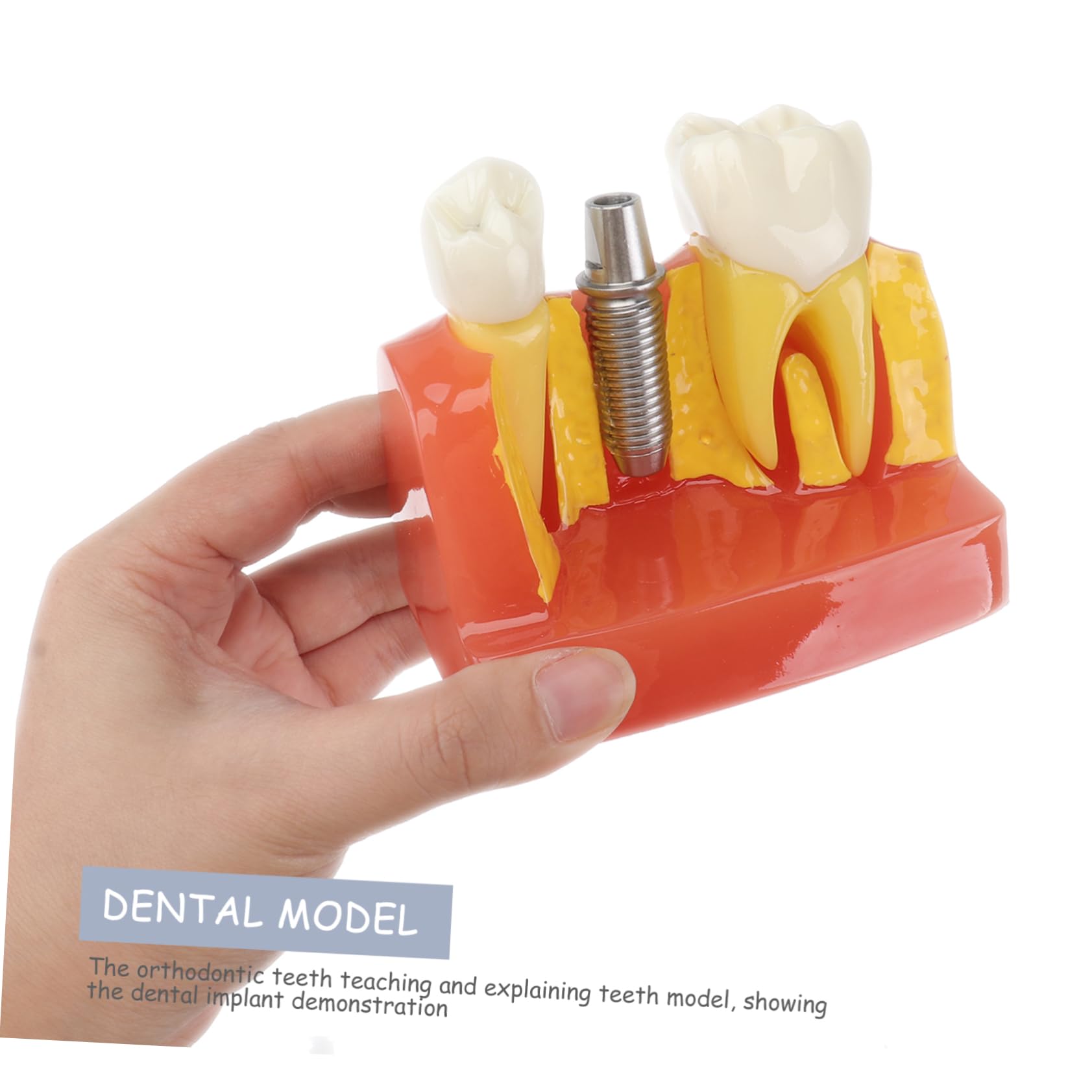 1pezzi Modello di Denti con Denti Rimovibili Strumento Didattico per Insegnamento e Studio Odontoiatrico Modello di Impianto e Protesi Fissa Incluso