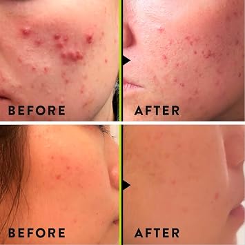 VERI Nitric Oxide + Salicylic Acid Clear Skin System (Peroxide-Free)- For Acne Prone Skin, Unclogs Pores, Clarifies Blemishes, Reduces Inflammation, Prevent Future Breakouts, 30 mL / 1 oz
