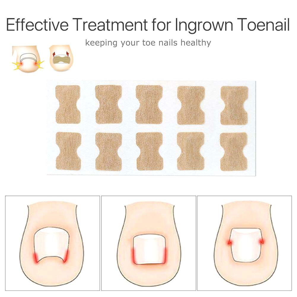 Juego de 5 parches de uñas sin pegamento – Kit de herramientas encarnadas para uñas de los pies para tratamiento de uñas, herramienta de corrección de uñas encarnadas para eliminar las uñas de los pies remiendo profesional para mantener las uñas saludable 4