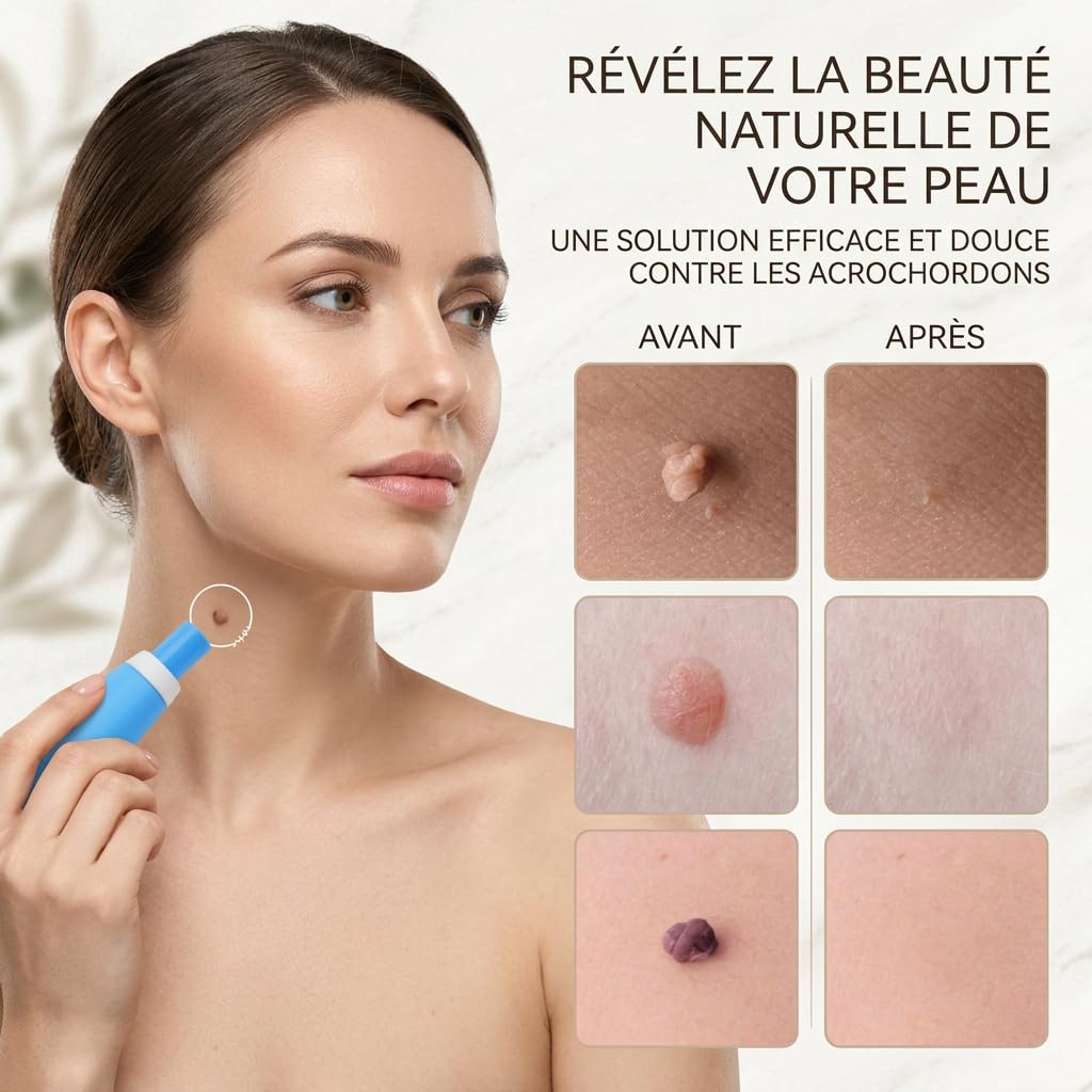 DermaSkin Pro Dermaskin Pro Acrochordon Traitement Efficace Solution Rapide Pour Éliminer Acrochordons Sans Cicatrice À La Maison (Bleu 1 ensemble)