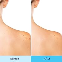 Vista 3 de Differin Spray corporal para acné, tratamiento de acné con ácido salicílico por los fabricantes de Differin Gel, fórmula 360 para acné de espalda